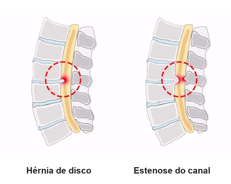 Hérnia de disco × estenose do canal: na estenose, o canal se fecha pelo disco, pelo ligamento e pelas articulações (ilustração: Naver Search, legendas traduzidas)