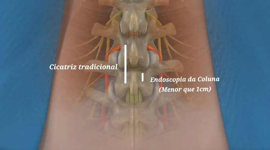 Tamanho da incisão: cirurgia tradicional e endoscopia de coluna