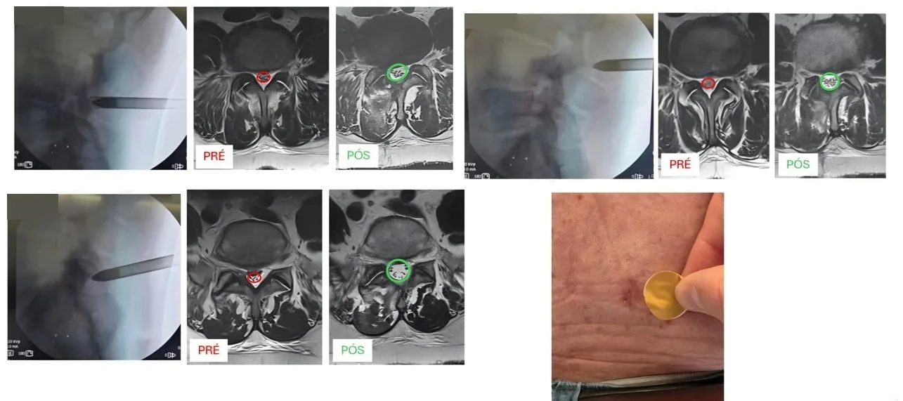 Descompressão de 3 níveis por uma incisão (PSLD): radioscopia, ressonância antes (vermelho) e depois (verde), e a incisão