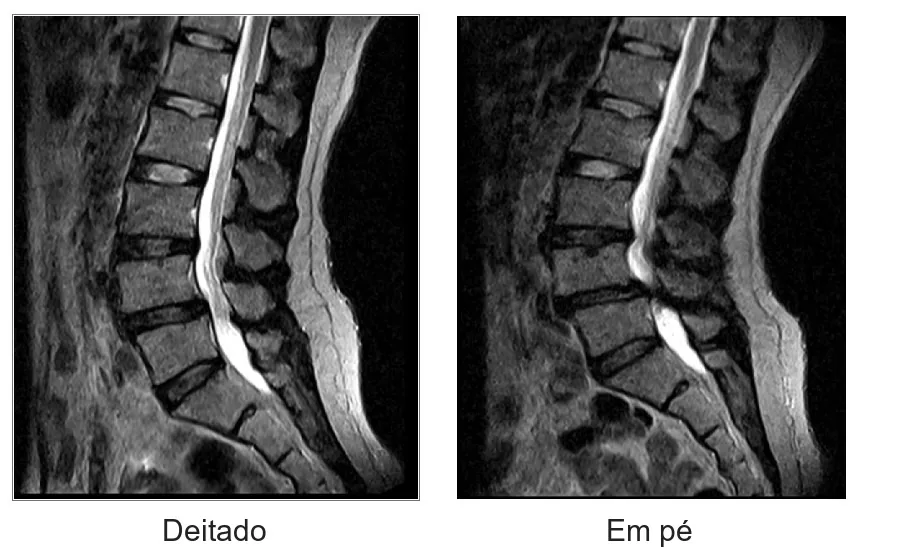 Ressonância da coluna lombar deitado e em pé: em pé, o canal se fecha
