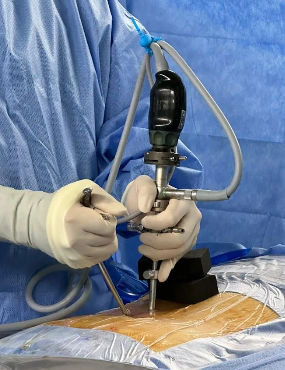 Endoscopia biportal (UBE): a câmera entra por um portal e o instrumento pelo outro
